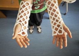 Ani sádra nemusí zkazit dovolenou. Její alternativa je dostupná i v našich nemocnicích